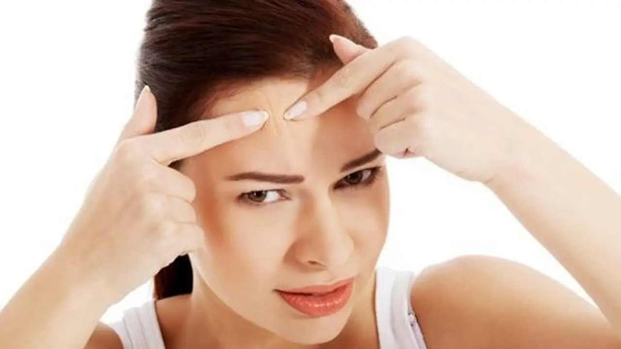 Jerawat di jidat./Copyright shutterstock.com