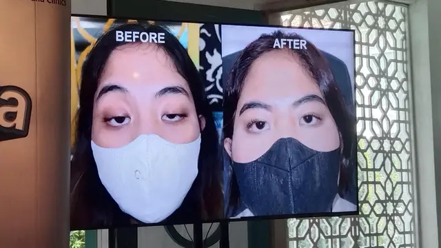 Sempat Viral di TikTok, Pricillia Bagikan Cerita Mata Ngantuk-nya Hingga Putuskan Untuk Operasi