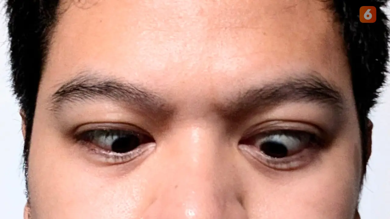 9 Gejala Mata Juling alias Strabismus, Apa Penyebab dan Bagaimana Cara Menanganinya?