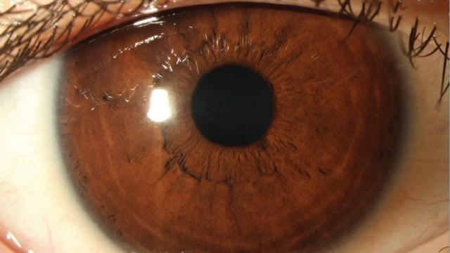 Infeksi Cacing Parasit Di Mata Beckley Ternyata Kasus Pertama Di