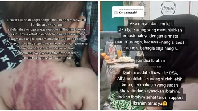 Viral Ibu Curhat Anaknya Berusia 13 Bulan Dikerok Baby Sitter, Netizen Ikut Kritik