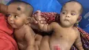 Tofa dan Tahura Bayi kembar siam saat sebelum operasi pemisahan di Rumah Sakit Medis Dhaka di Dhaka, Bangladesh (2/8). Dokter ahli bedah di Bangladesh telah berhasil memisahkan bayi kembar siam berusia 10 bulan tersebut. (AFP Photo/ Abdul Hanif Tablu)