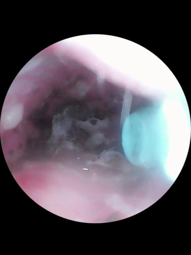 Bikin Merinding, Telinga Wanita Ini Gatal Karena Jadi Sarang Laba-Laba