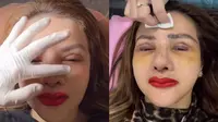 Barbie Kumalasari Operasi Plastik ke-9 Demi Mata ala Kylie Jenner Disorot Media Asing