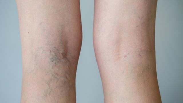 8 Ciri-Ciri Varises pada Kaki, Lengkap Penyebab dan Cara Menghilangkannya