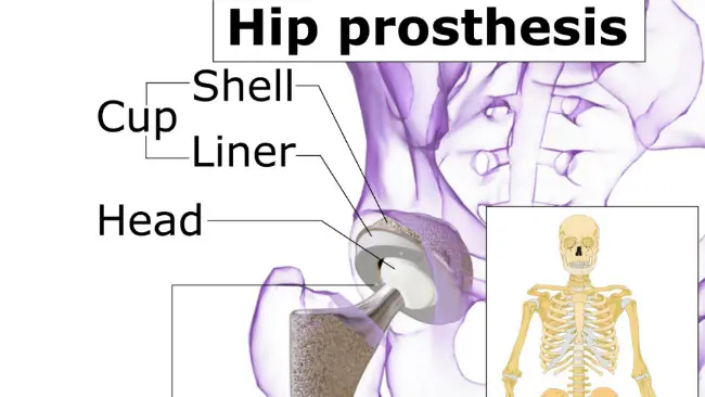 Ilustrasi komponen-komponen protesis panggul. (Sumber Wikimedia Commons)