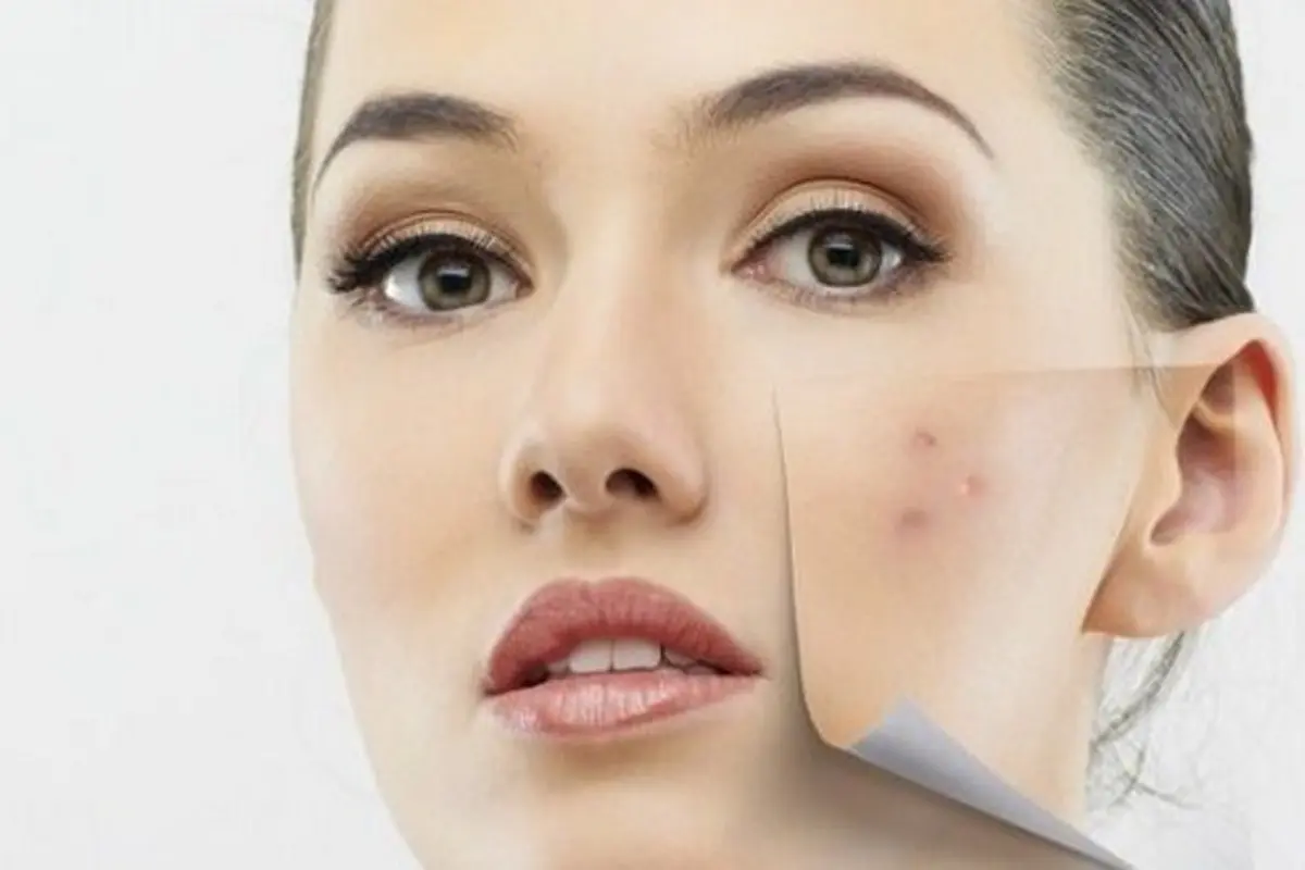 Hilangkan Bekas Jerawat dengan 2 Bahan Alami Super Ampuh