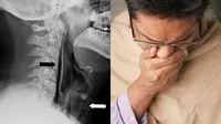Tenggorokan Pria Ini Pecah Usai Menahan Bersin Demi Bersikap Sopan (Sumber: Leicester Hospital, Pexels)