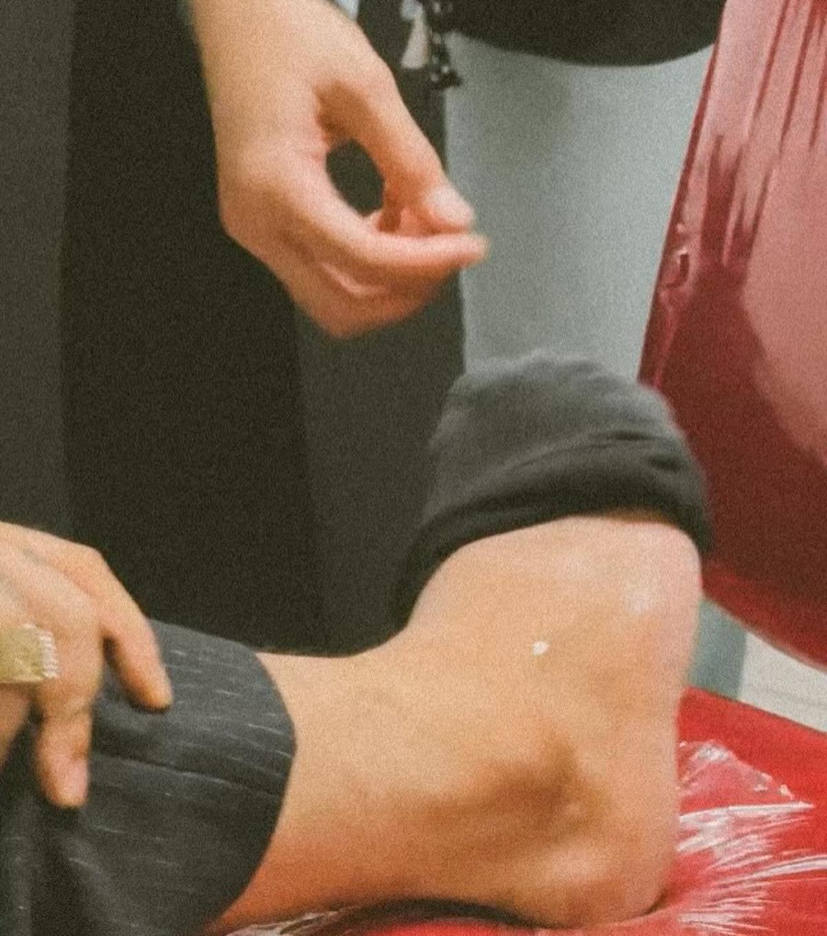 Onadio Leonardo Alami Insiden saat Manggung hingga Kakinya Diperban