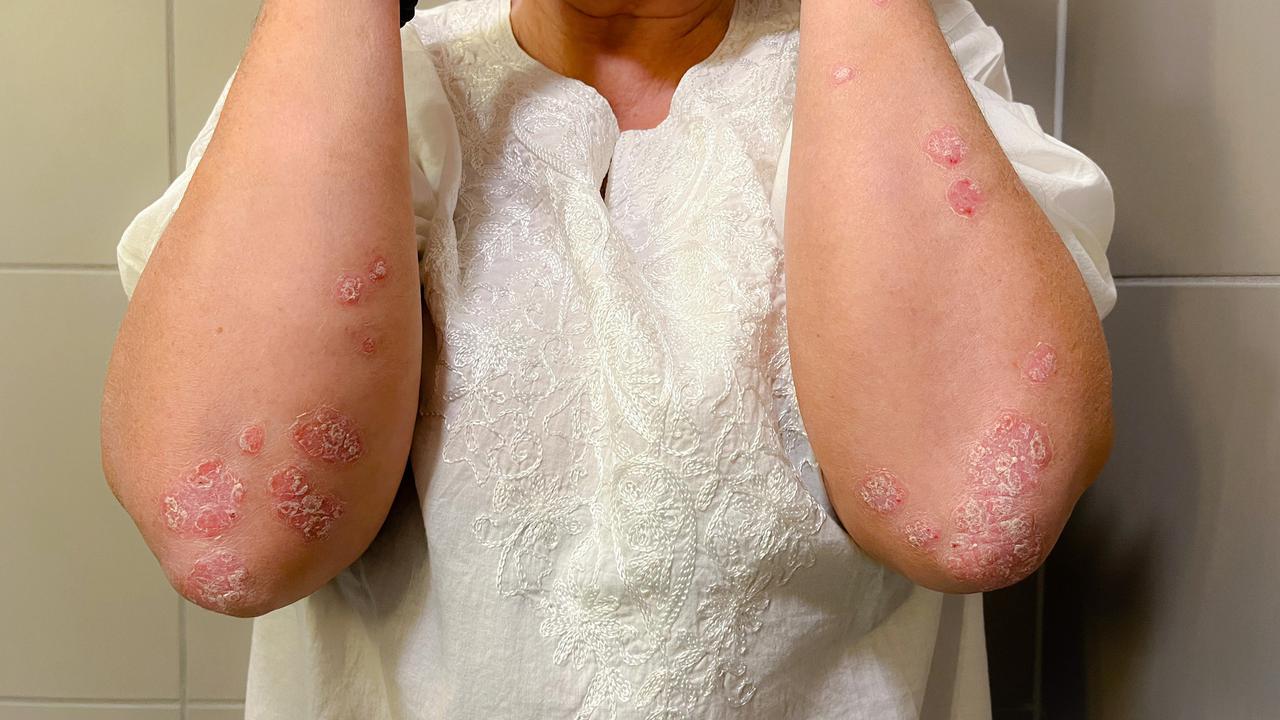 Psoriasis