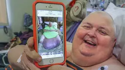 Roger Logan menunjukkan foto dirinya sebelum operasi pengangkatan tumor seberat 58,97 kg yang tumbuh selama 12 tahun terakhir di dalam perutnya, di RS Bakersfield Memorial, California, 2 Februari 2017. (Henry A. Barrios/The Bakersfield Californian via AP)
