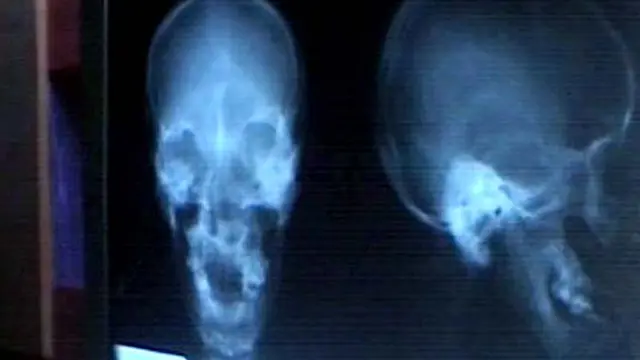 Dokter Minta Pasien Jarum Temui Ahli Magis