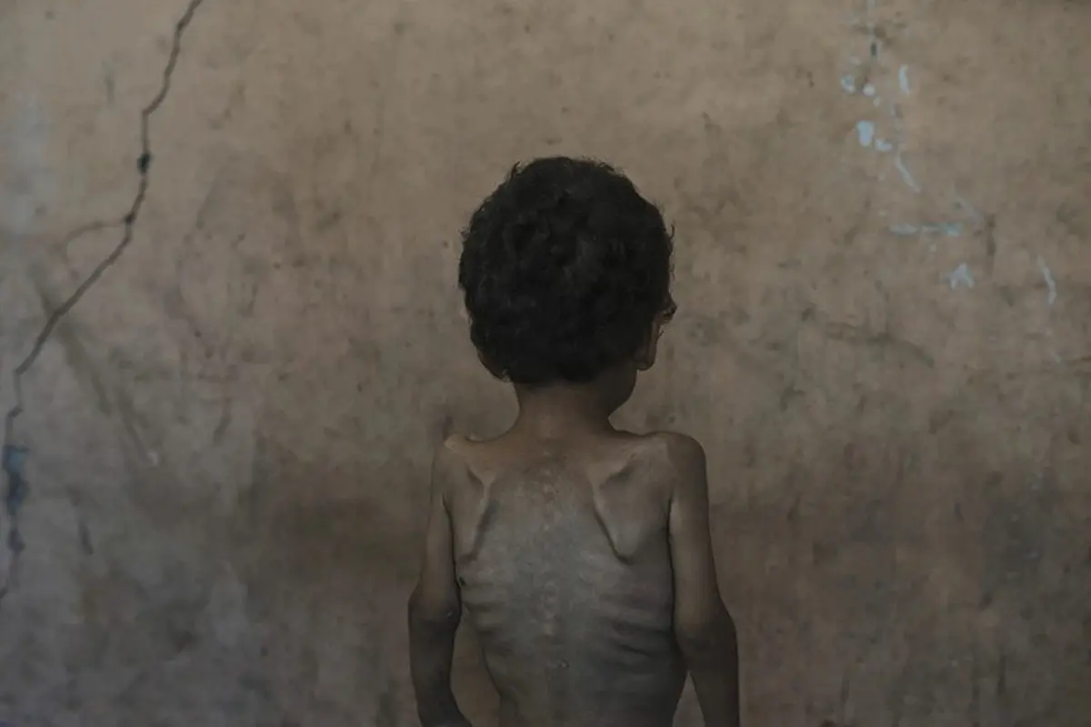 Yazan Abu Ful, balita usia dua tahun yang mengalami malnutrisi berada di Kamp Pengungsi Shati, Gaza, Rabu (23/7/2025).