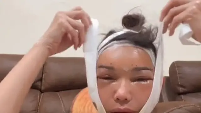 Wajah Bunda Corla Usai Oplas