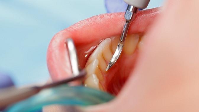Karang dan plak gigi yang harus selalu dibersihkan. (Image: res.cloudinary.com)