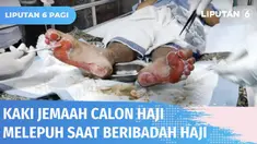 Sejumlah jemaah calon haji Indonesia mengalami kaki melepuh usai pulang dari ibadah di Masjid Nabawi. Cuaca panas yang mencapai 42 derajat celcius dan tidak menggunakan alas kaki jadi penyebab utama jemaah alami kaki melepuh.