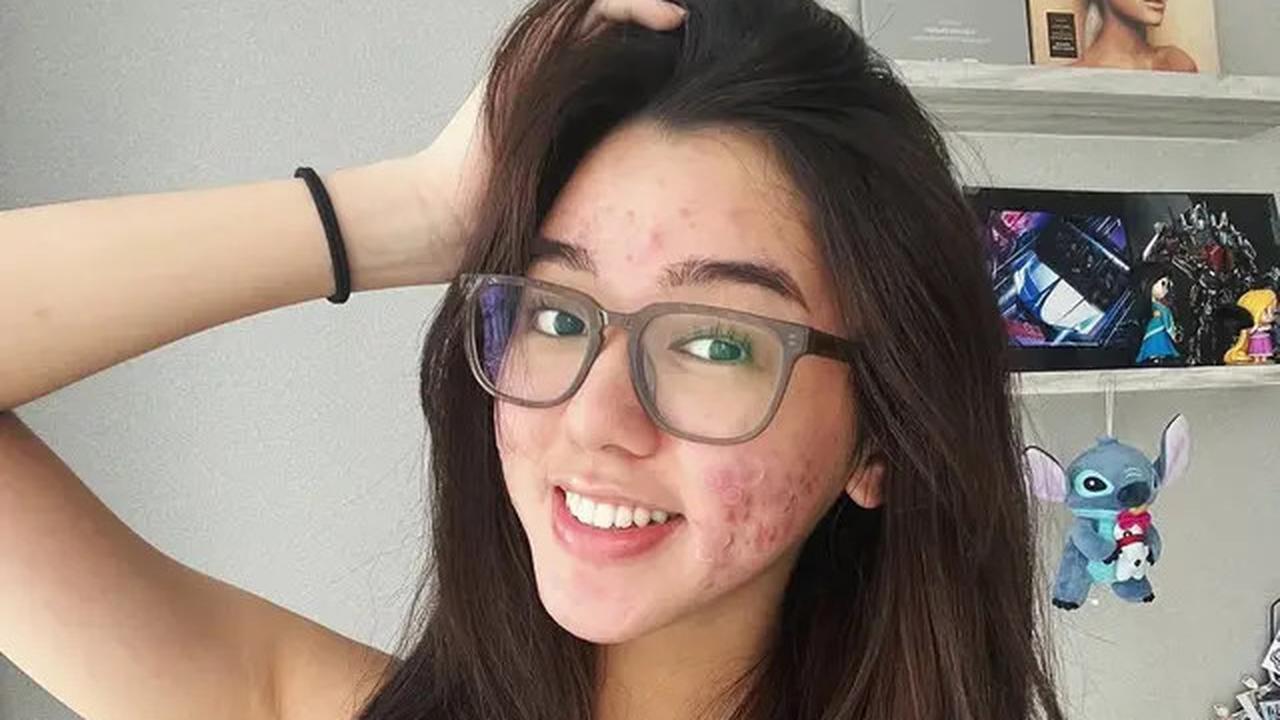 6 Potret Wajah Gabriella Ekaputri Berjerawat, Tetap Percaya Diri Tampil Natural