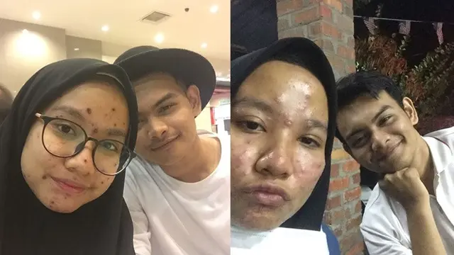 Tetap Setia dengan Pacar yang Berjerawat, Pria Ini Tulis Pesan yang Menyentuh
