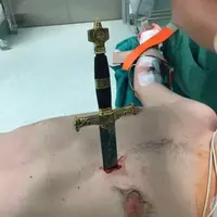Sebuah pedang tertancap di dada seorang pria sehingga ia harus dioperasi.