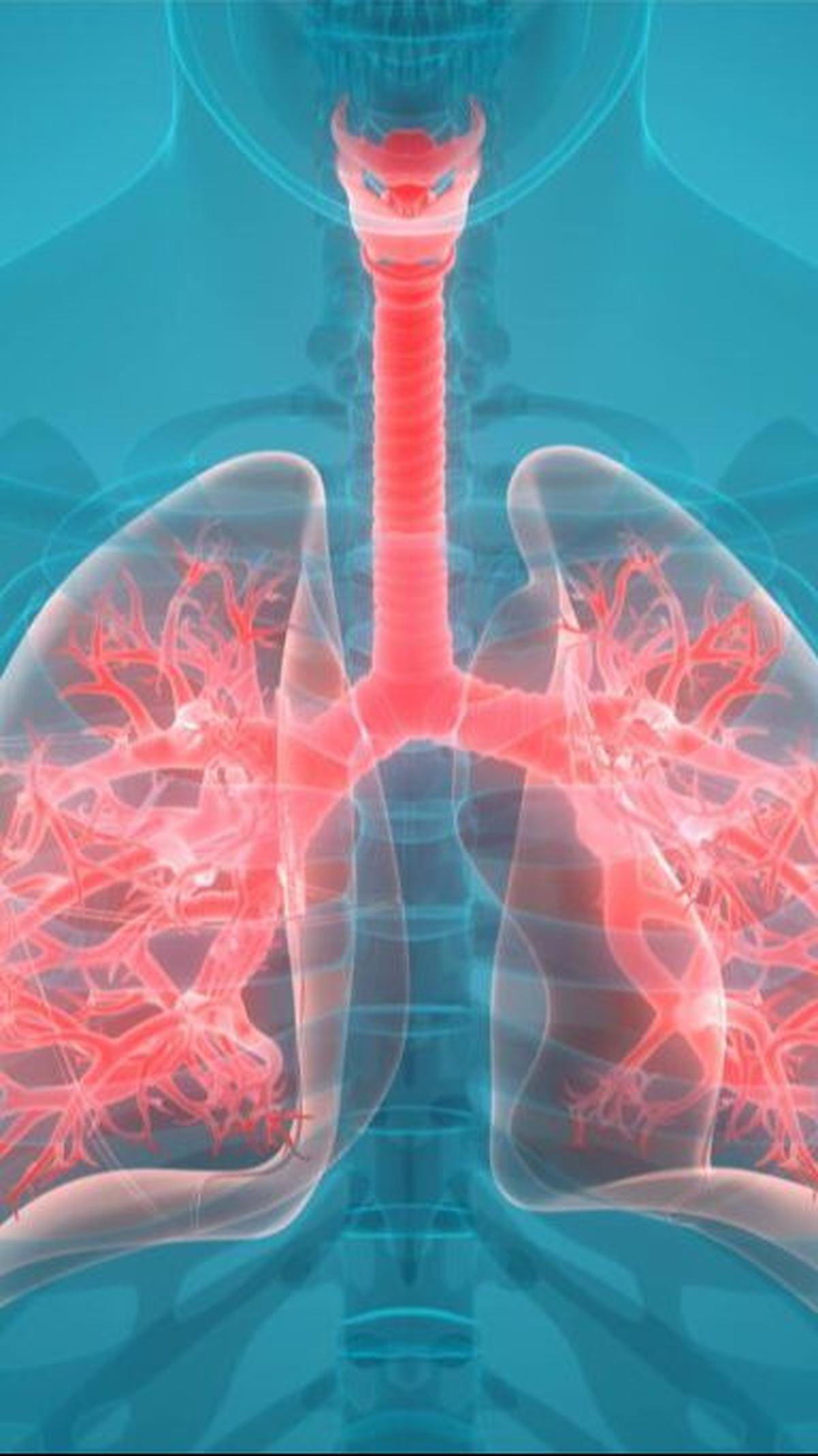 <b>Pneumonia</b>