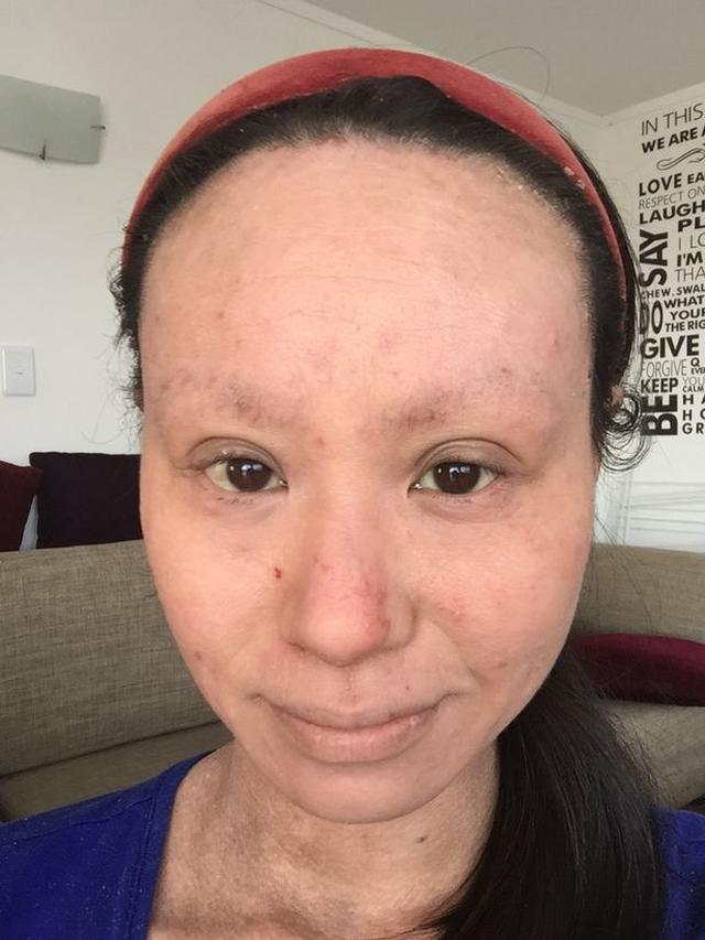 Kisah Perjuangan Wanita Atasi Eksim Hingga Membuat Wajahnya Berubah Ini Bikin Pilu