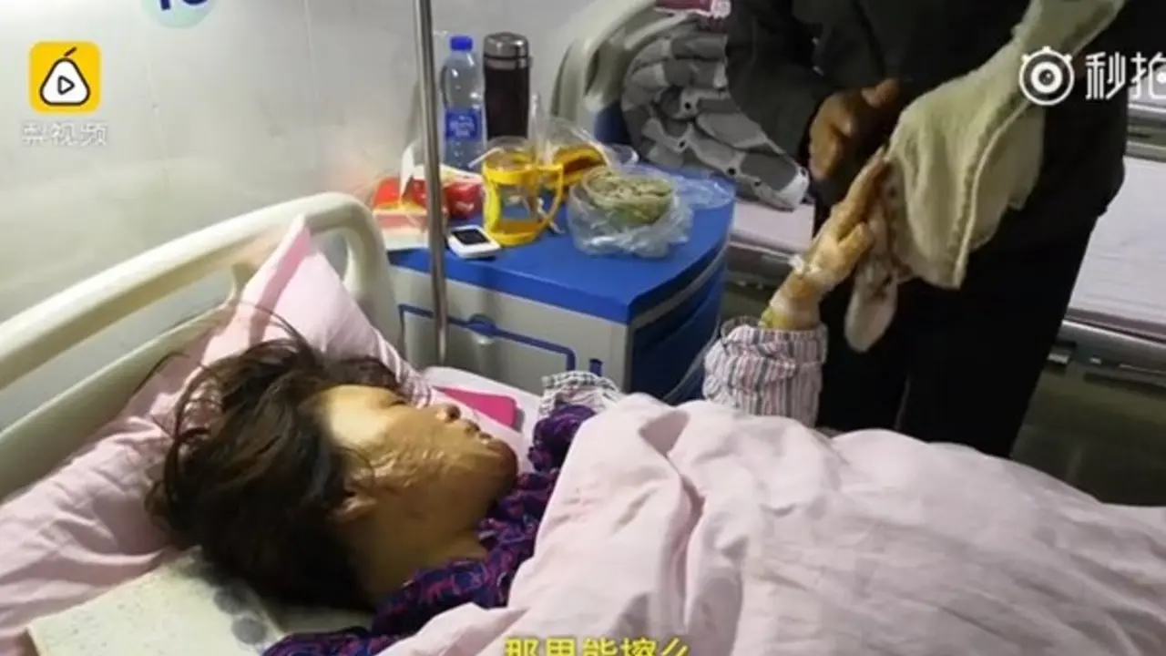 [Bintang] Diceraikan Suami Usai Wajah Terbakar, Kisah Wanita Ini Jadi Viral