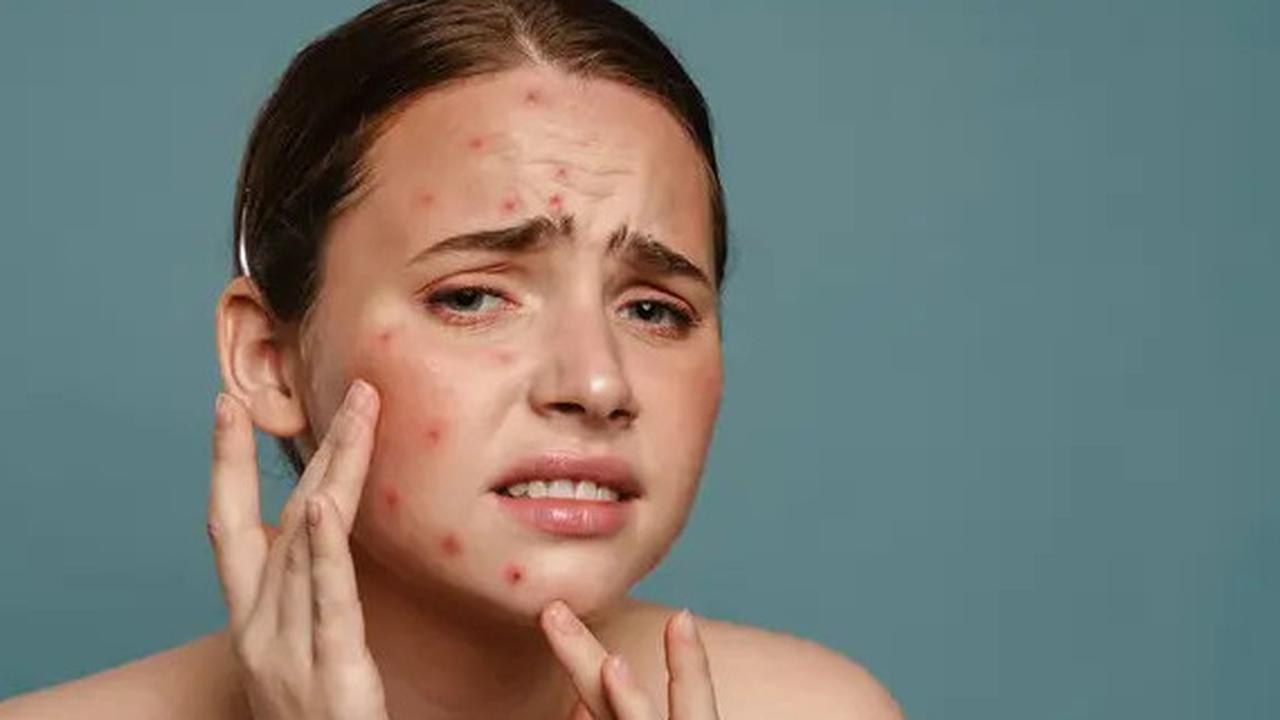 Benarkah Bawang Putih Ampuh Atasi Jerawat? Ini Fakta dan Efek Sampingnya yang Perlu Diketahui