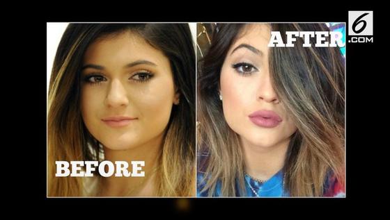 VIDEO: Kylie Jenner Lakukan 6 Operasi Plastik Ini