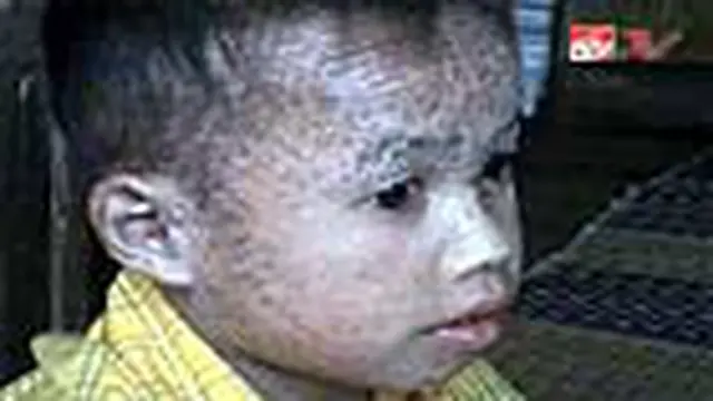 Tubuh Rohmat Dipenuhi Sisik Seperti Ikan
