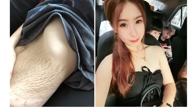 Ibu Empat Anak Dianggap Menjijikan Setelah Unggah Foto Stretch Mark