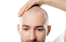 12 Cara Mencegah Rambut Menipis dan Menjadi Botak