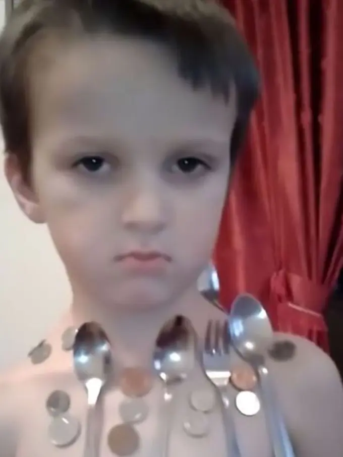 [Bintang] Kayak Magneto di X-Men, Badan Bocah Ini Juga Bisa Serap Logam