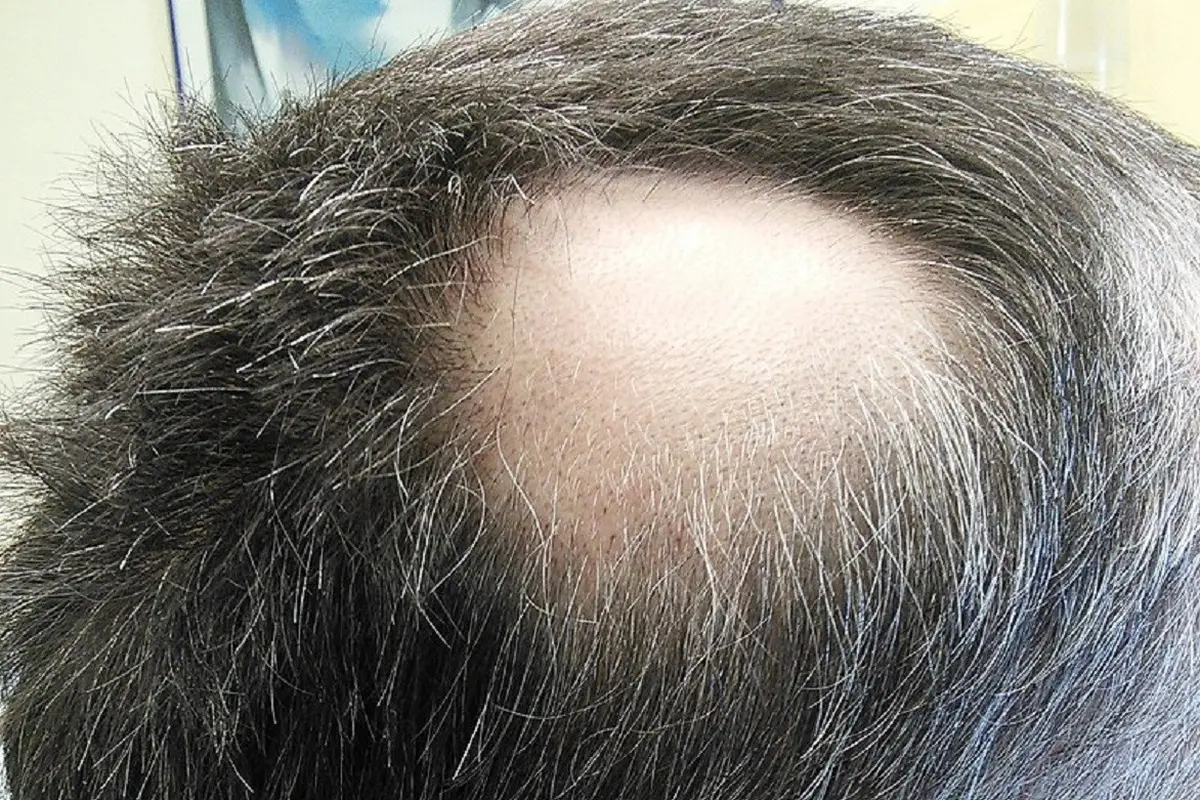 Alopesia