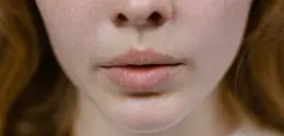 Penjelasan terkait Melasma oleh Kalbe, mulai dari penyebab hingga cara penyembuhannya. (pexels.com/Tima Miroshnichenko)