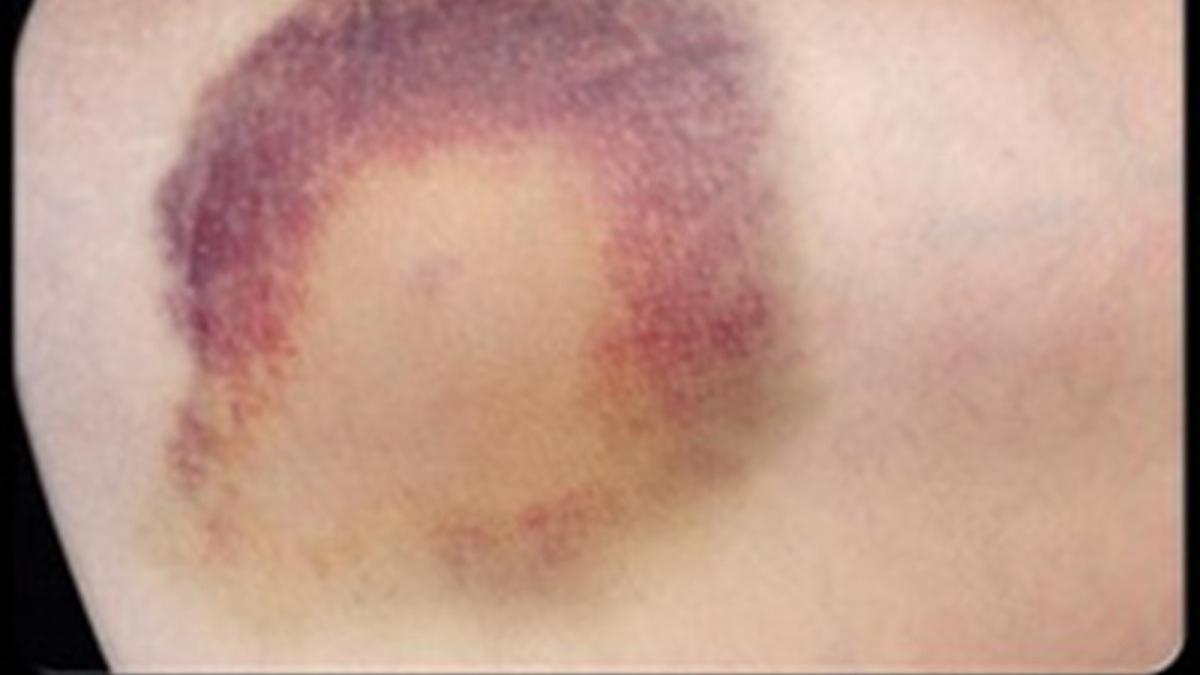 9 Gejala Internal Bleeding yang Perlu Diwaspadai, Harus Segera Diatasi