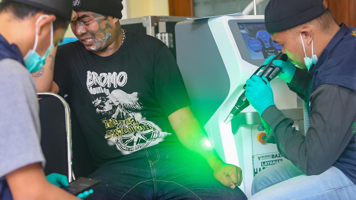 Masuk Tahun Keempat, Program Hapus Tato Gratis Targetkan 700 Peserta