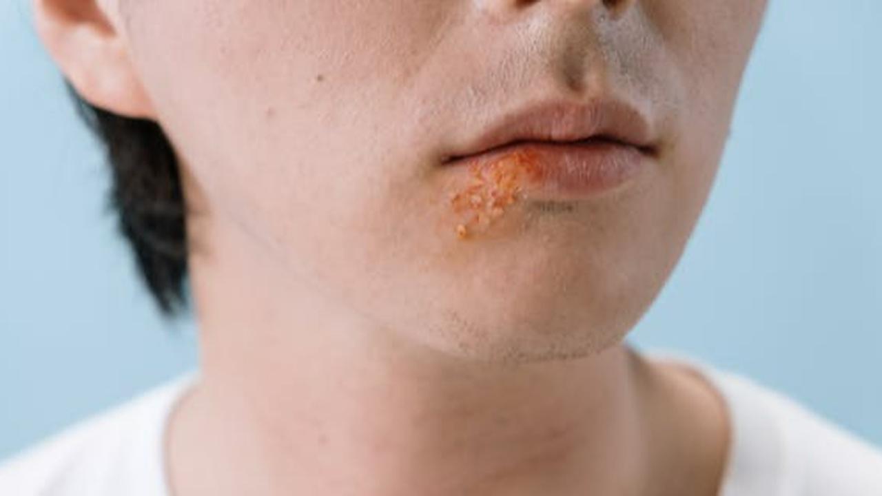 Herpes Genital Bisa Menyerang Siapa Saja, Begini Cara Mencegahnya