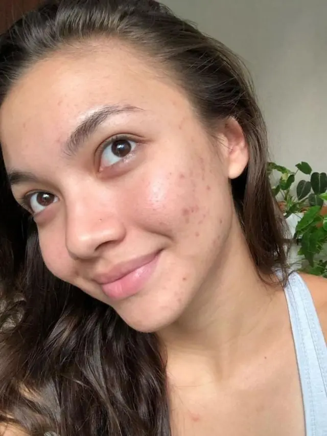 Potret 6 Seleb Unggah Foto Bare Face Lagi Berjerawat, Cintai Diri Sendiri Apa Adanya