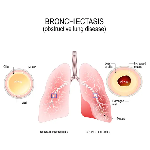 Penyakit Bronkitis (sumber: iStock)