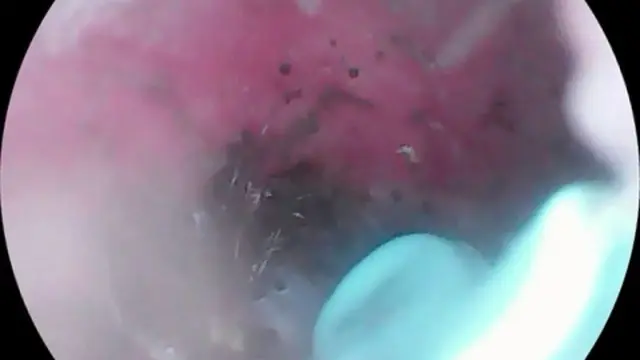 Bikin Merinding, Telinga Wanita Ini Gatal Karena Jadi Sarang Laba-Laba