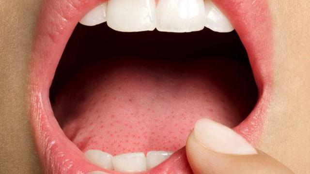 10 Penyebab Kanker Mulut yang Perlu Diwaspadai, Kenali Tanda-Tandanya