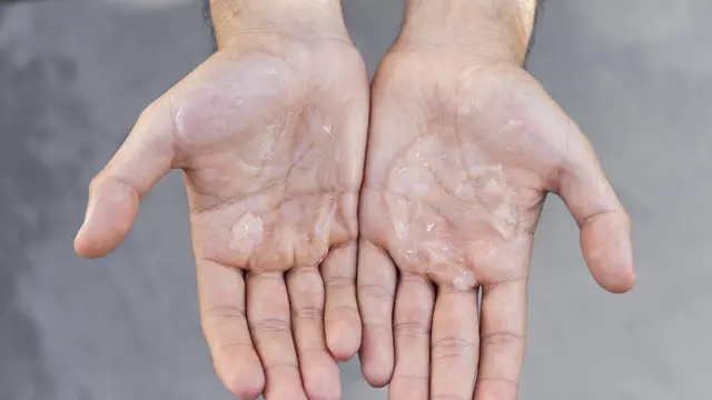 Penyebab Telapak Tangan & Kaki Berkeringat