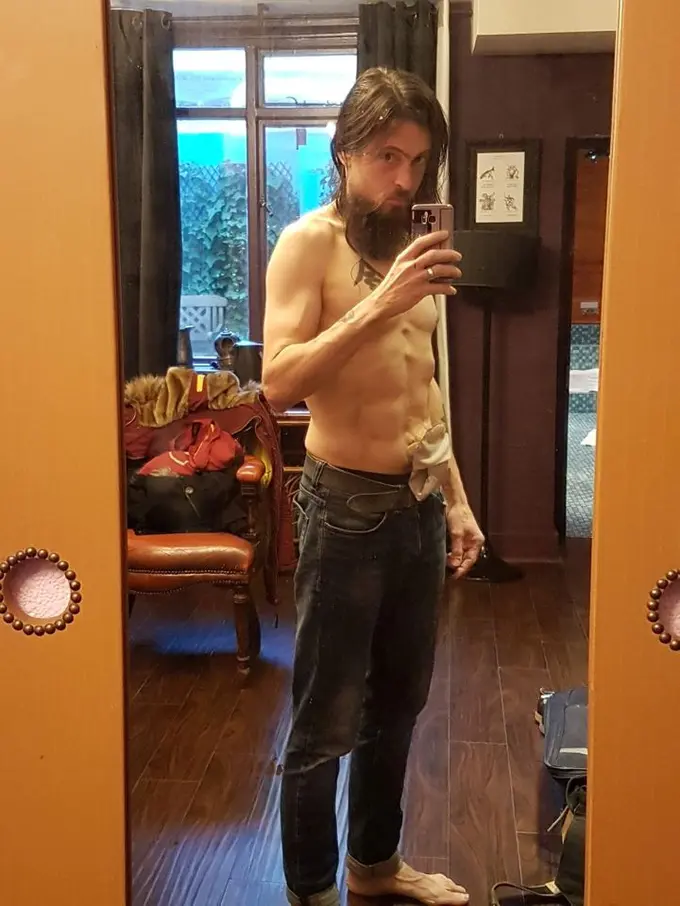 Idap Penyakit Usus Kronis dan Harus Hidup dengan Kantong untuk Buang Air Besar di Perutnya, Pria Ini Justru Bangga