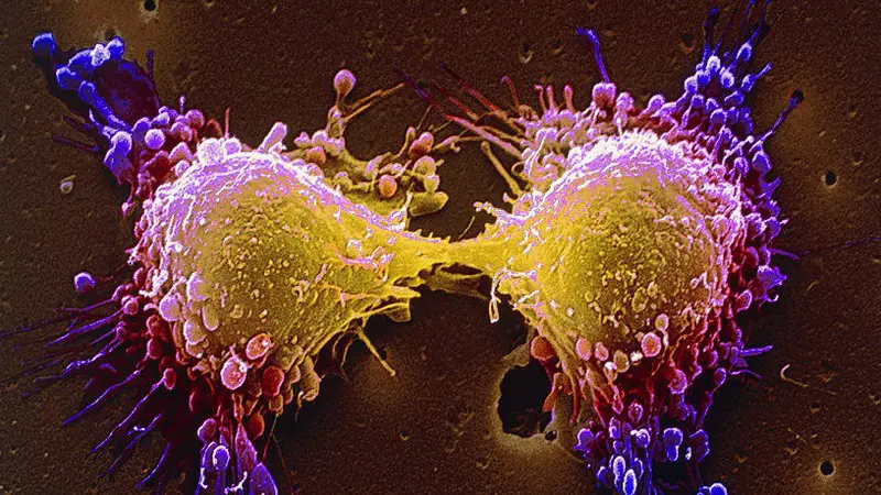 Kenapa Sebagian Besar Jenis Kanker Sulit Dicegah?