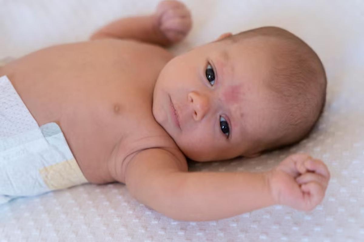 Ruam Popok (Diaper Rash)