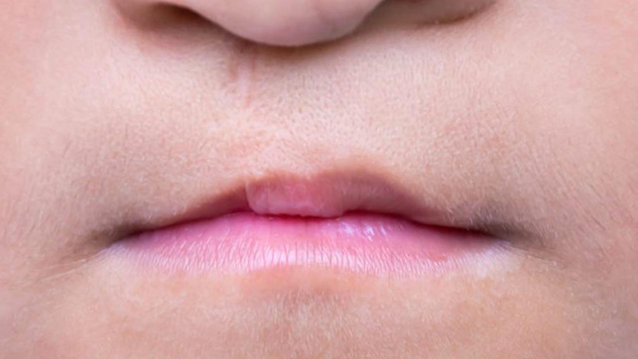 ilustrasi bibir sumbing
