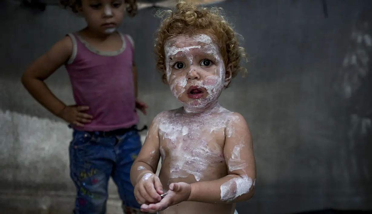 Seorang anak pengungsi Sham al-Hessi yang menderita penyakit kulit diolesi krim kulit saat berpose untuk difoto, di kamp tenda darurat di Deir al-Balah, Jalur Gaza tengah, Senin (29/7/2024). (AP Photo/Abdel Kareem Hana)