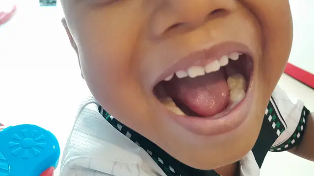Gigi anak bersih bebas karies. (Foto: Liputan6.com/Benedikta Desideria)