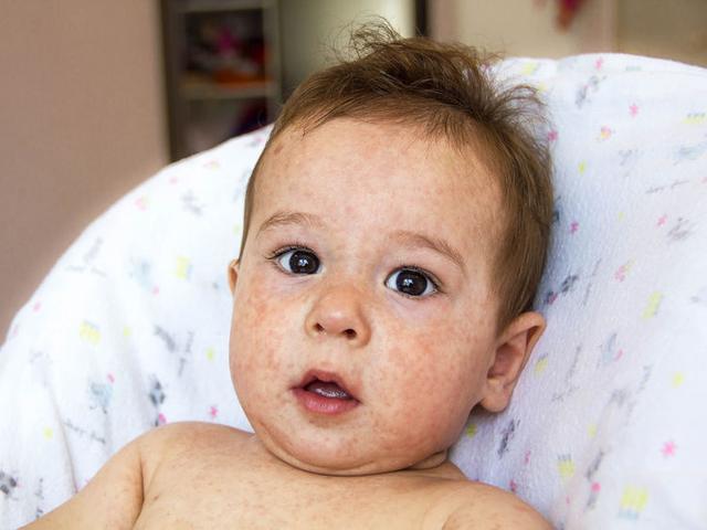 Penyakit Eksim Penyebab Dan Cara Penanganan Agar Cepat Sembuh Health Liputan6 Com