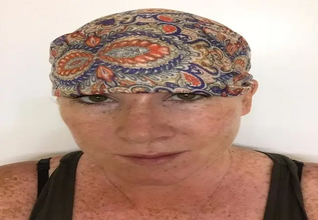 Bethany sempat kehilangan rambutnya karena rontok saat radiasi